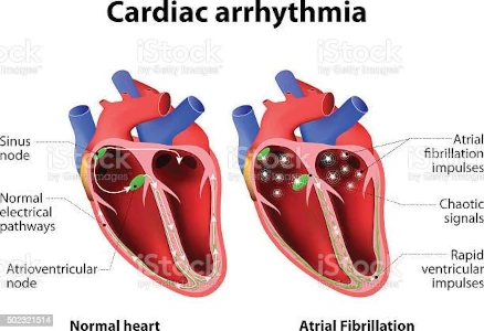 Arrhythmie